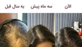خرید عمده 10عددی تونیک رشد مو اصل تضمینی ۳۰۰ میل ارسال مستقیم از شرکت ایرانیان زمین
