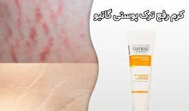 کرم رفع ترک های پوستی ناشی از بارداری وچاقی و لاغری گاتیو ایتالیا 100 میل